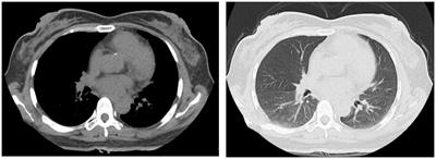 Case report: Fatal Legionella infection diagnosed via by metagenomic next-generation sequencing in a patient with chronic myeloid leukemia